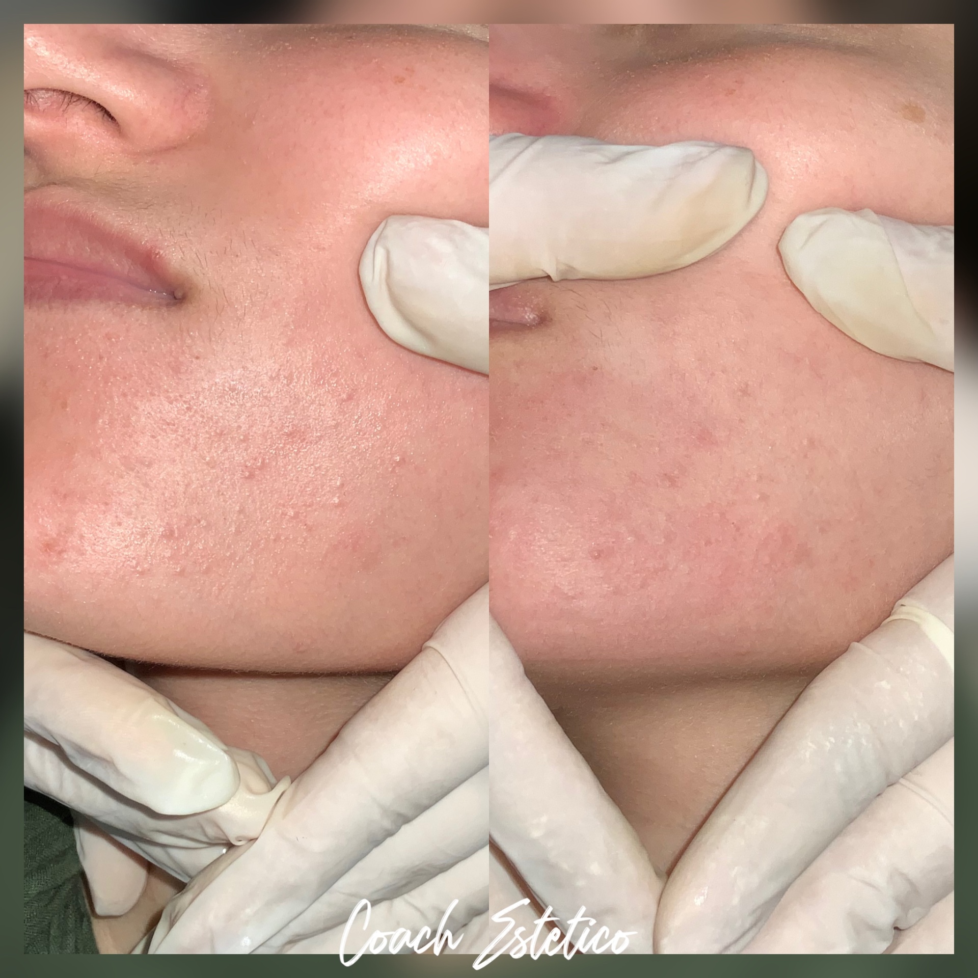 Caso de éxito antes y después con limpieza facial profesional
